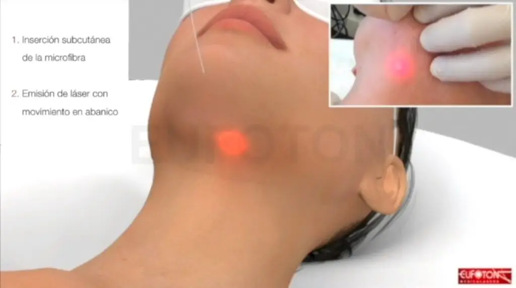 Tratamiento con endolift en Bilbao