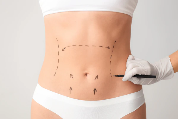 Abdominoplastia-Bilbao