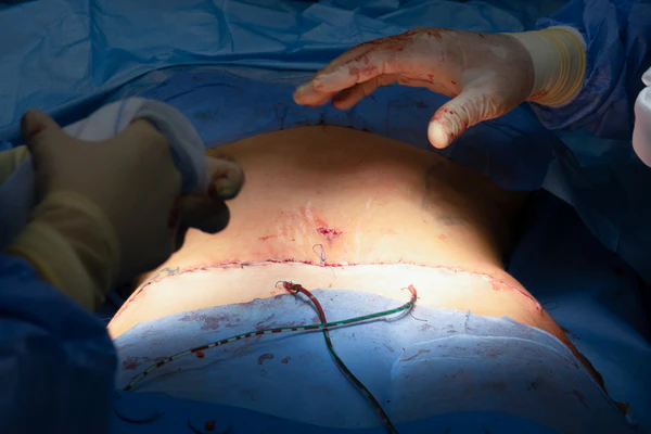 Abdominoplastia Bilbao