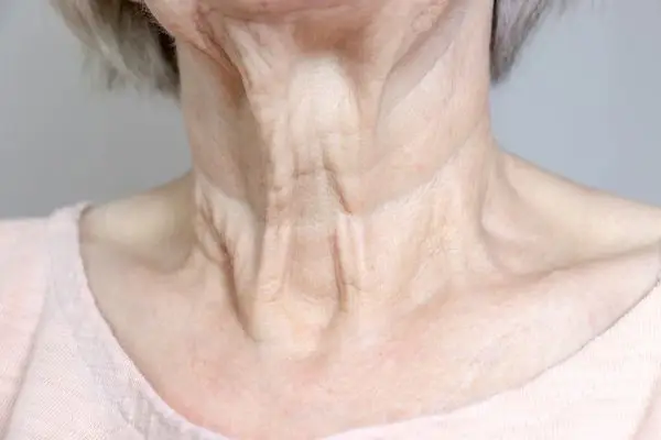 Neuromoduladores para rejuvenecimiento de cuello en Bilbao